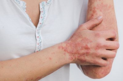 psoriasis-5996424_640 Psoriasis